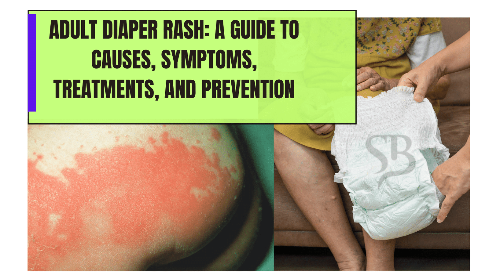 Adult Diaper Rash: A Guide to Causes, Symptoms, Treatments, And Prevention