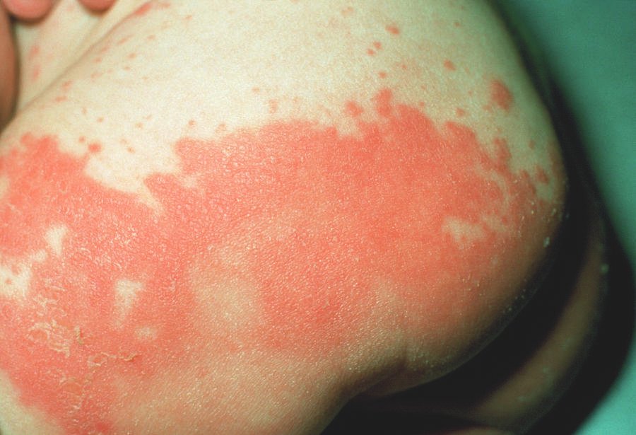 Rashes caused by Diaper